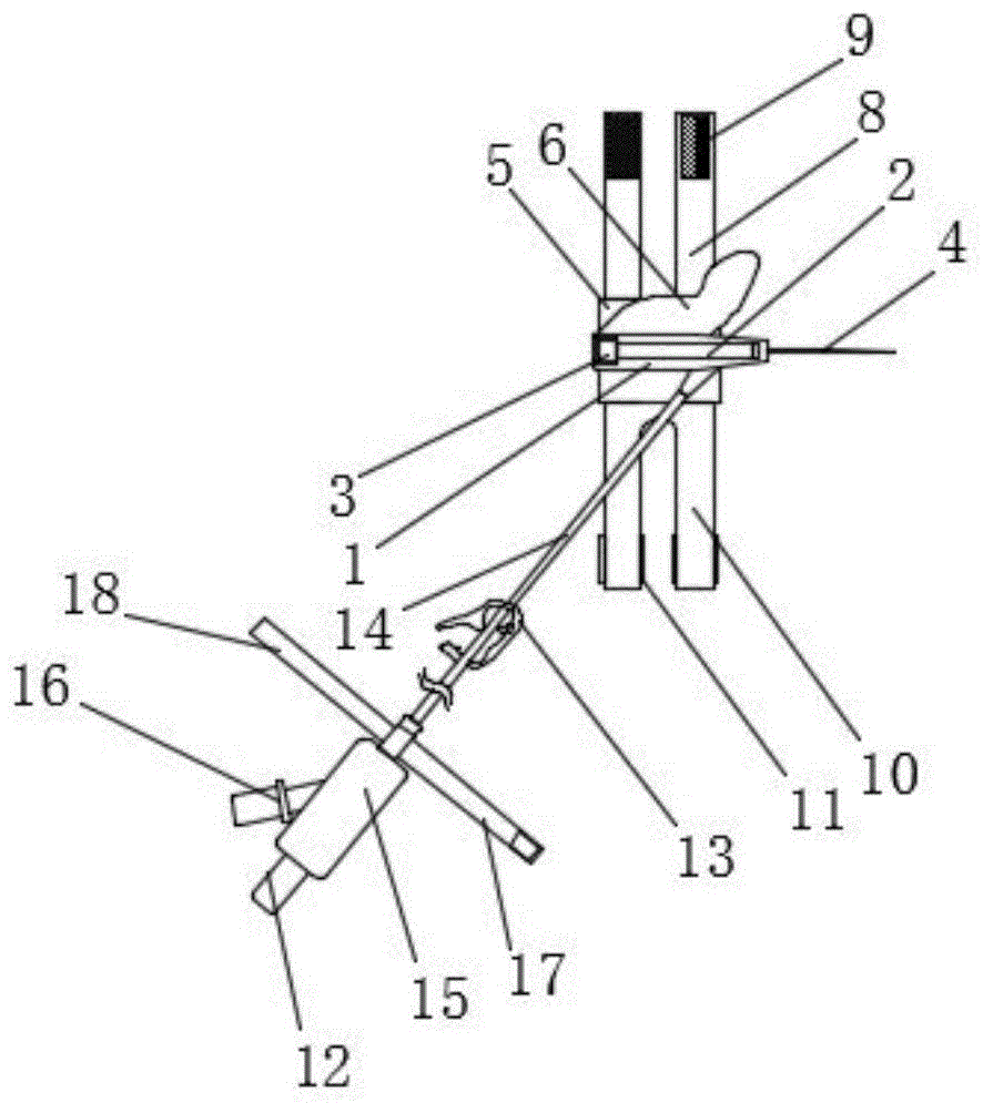 一种带固定结构的留置针的制作方法