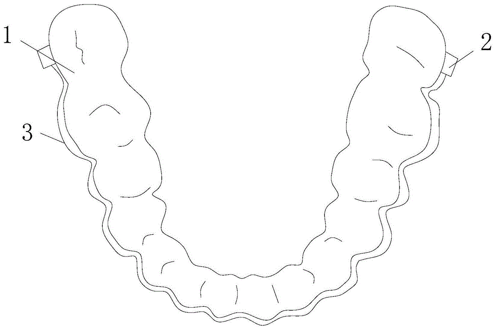 一种牙齿矫正用隐形固定矫治装置的制作方法