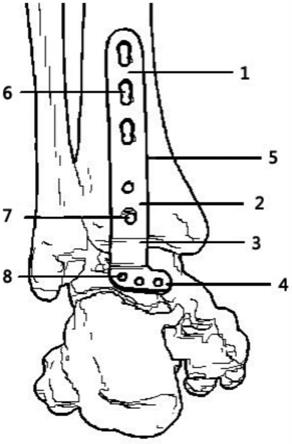 一种踝关节后方融合钢板的制作方法