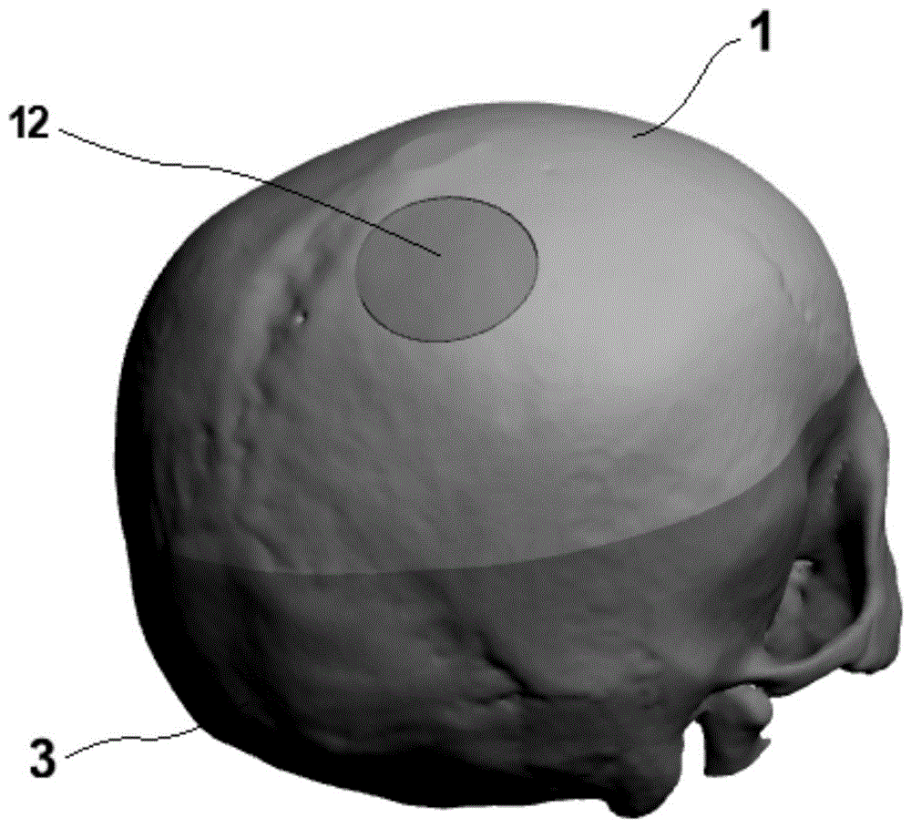 用于穿刺训练的3D打印脑出血模型及其高效制作方法