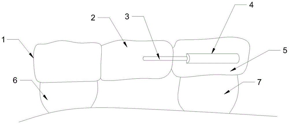 一种栓体栓道式功能性间隙保持器的制作方法
