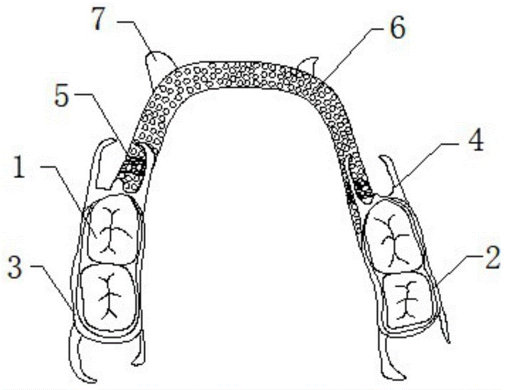一种树脂基托牙的钴铬支架义齿及其制备方法与流程