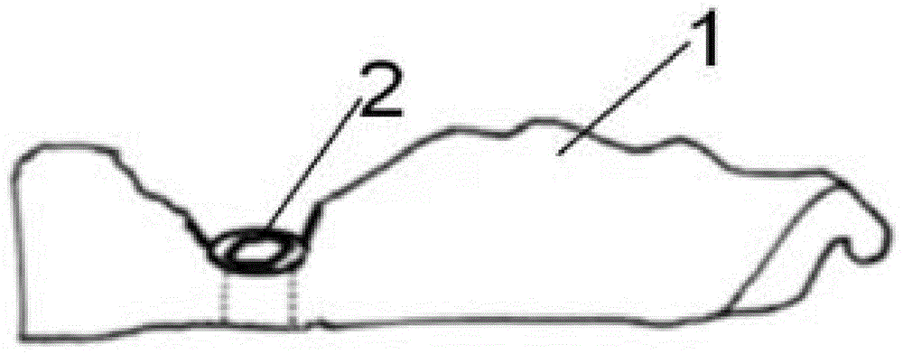 移植牙窝备孔导板及其制作方法