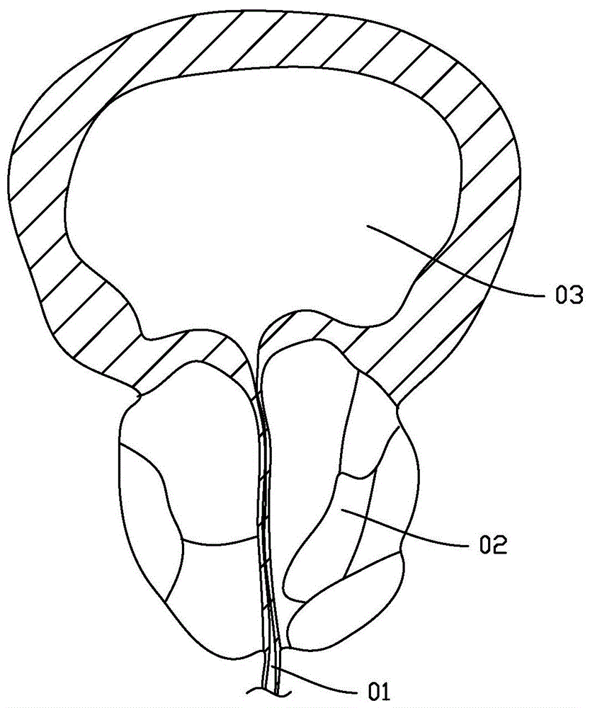 一种尿道内按压前列腺的装置的制作方法