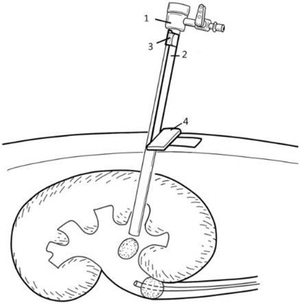 一种经皮肾镜外鞘的防滑脱固定装置的制作方法