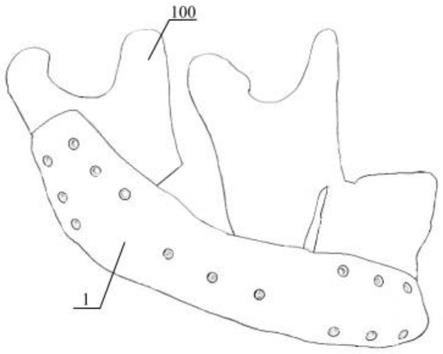 一种下颌骨修复体及其制造方法与流程
