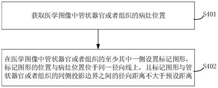 病灶标记方法、电子装置和存储介质与流程