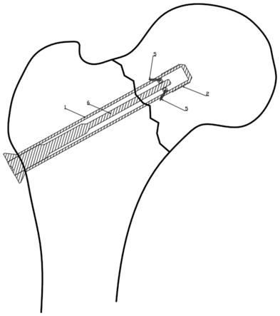 一种预防股骨折后骨头坏死装置的制作方法