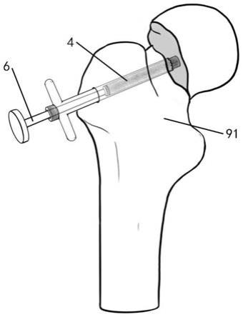 一种股骨颈骨折植骨组件及植骨方法与流程