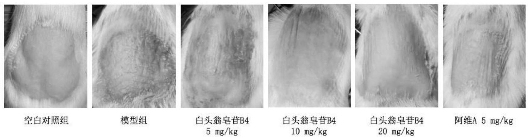 白头翁皂苷B4在制备治疗或预防银屑病的药物的用途的制作方法