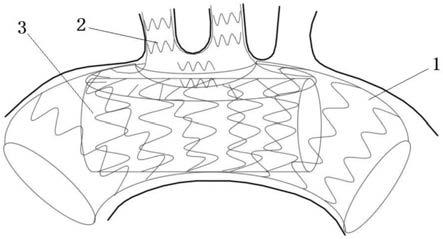 用于重建主动脉弓部及其分支的覆膜支架