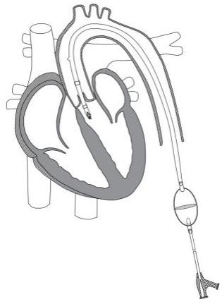 一种体外左心室辅助装置的制作方法