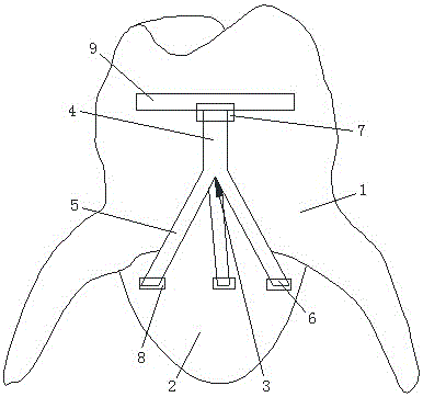 一种防松脱义齿的制作方法与工艺