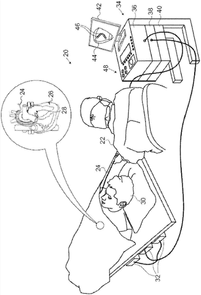 自動消融跟蹤的制作方法與工藝