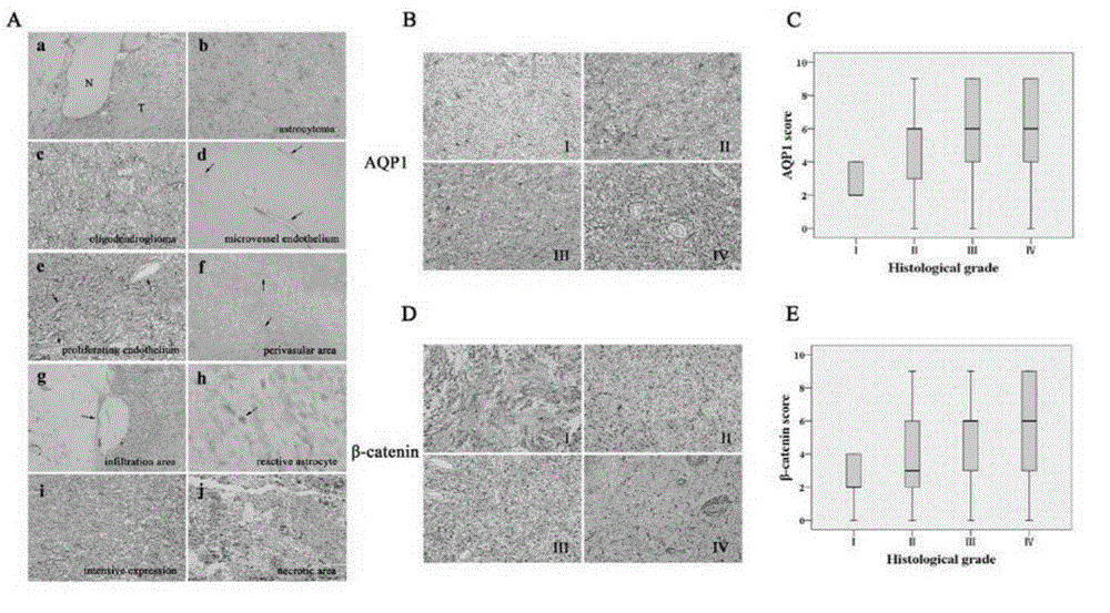 AQP1及β-catenin与肿瘤病理分级之间的正向关系的制作方法与工艺