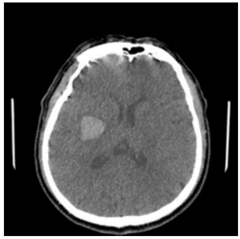 基于半监督学习的脑部CT图像出血区域分割方法及系统与流程