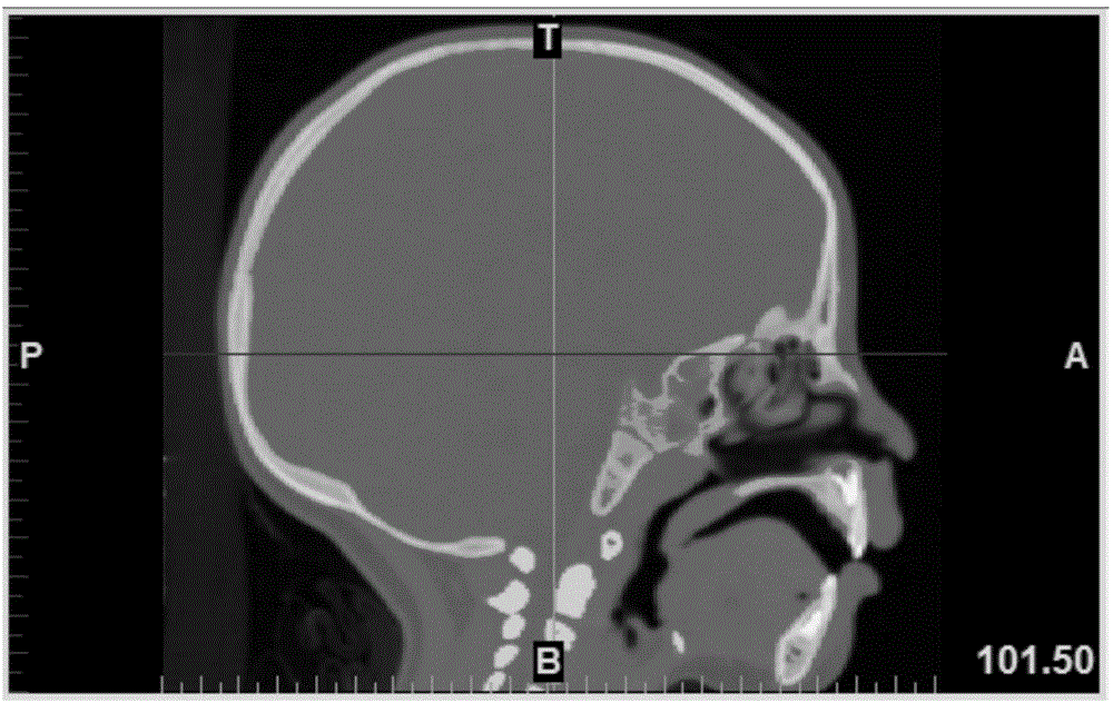一种基于头颅薄层CT扫描数据的额骨角测量方法与流程
