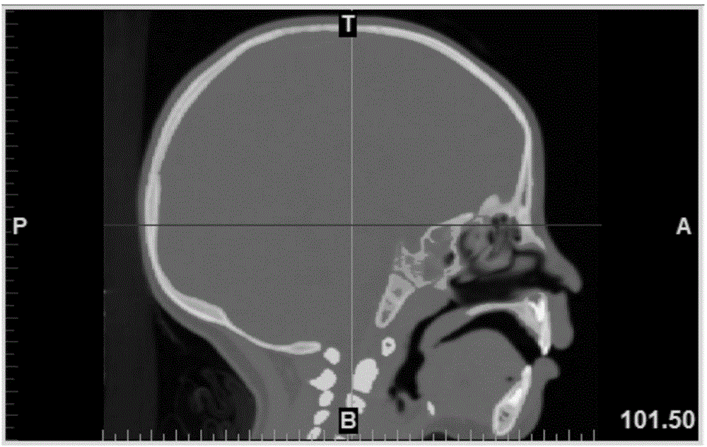 一種基于頭顱薄層CT掃描數(shù)據(jù)的額骨角測量方法與流程