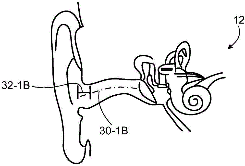 具有柔性翼片的听筒的制作方法与工艺