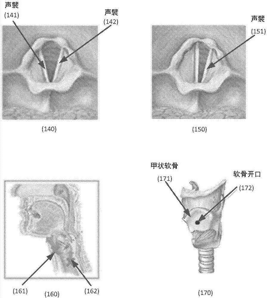 喉镜下声门解剖图图片