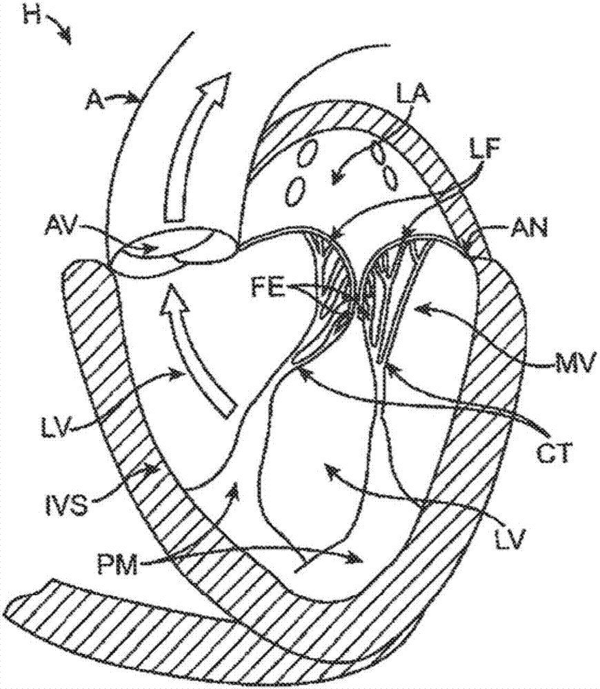 人工心脏瓣膜装置,人工二尖瓣和相关系统及方法与流程