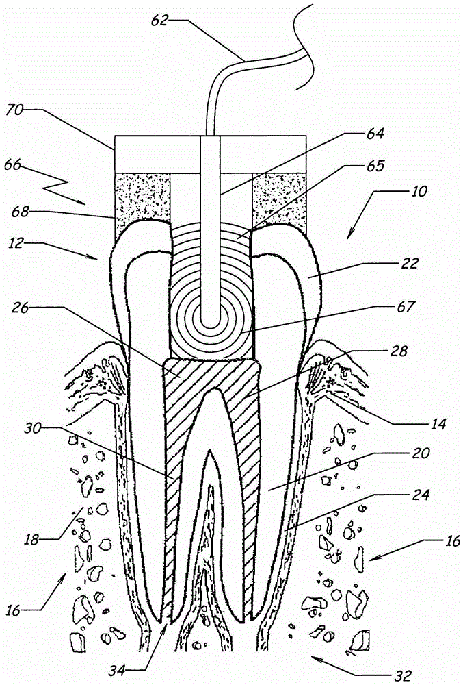 用于牙髓治療的設(shè)備、方法和組合與流程