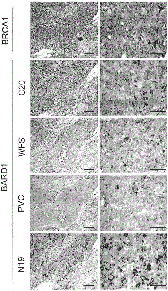 肺癌和結直腸癌中的BARD1同工型、其檢測方法及其應用與流程