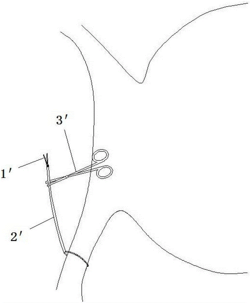 血管阻斷帶的制作方法與工藝