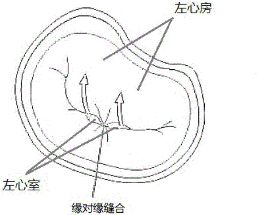 一種瓣膜夾合器的制作方法與工藝