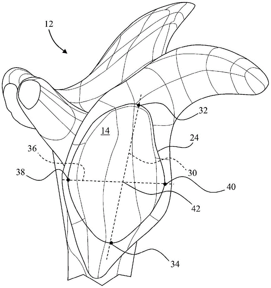 用于肩關(guān)節(jié)成形術(shù)的組合式擴(kuò)孔鉆/鉆頭的制作方法與工藝