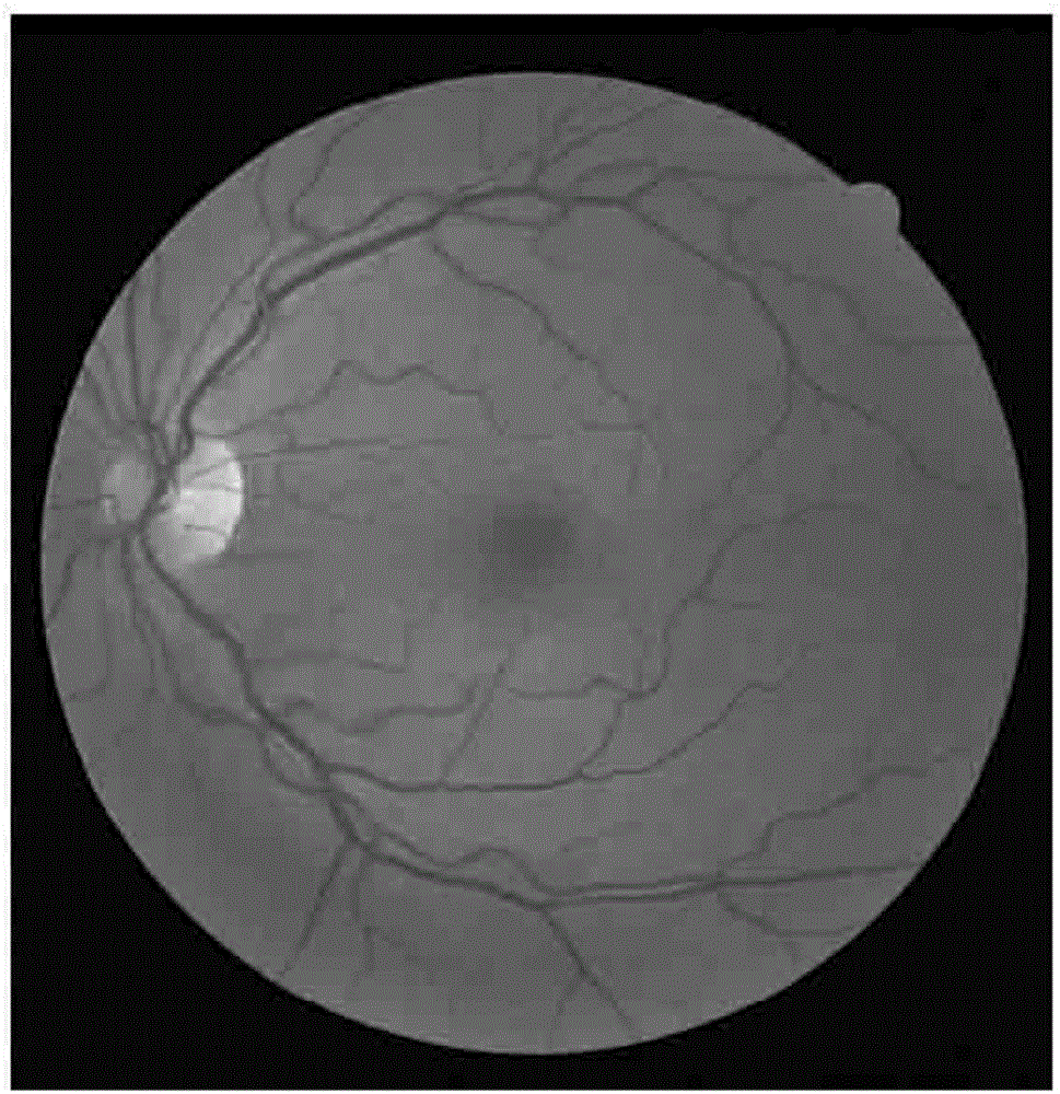 一種視網膜病變的眼底圖像分類方法和裝置與流程