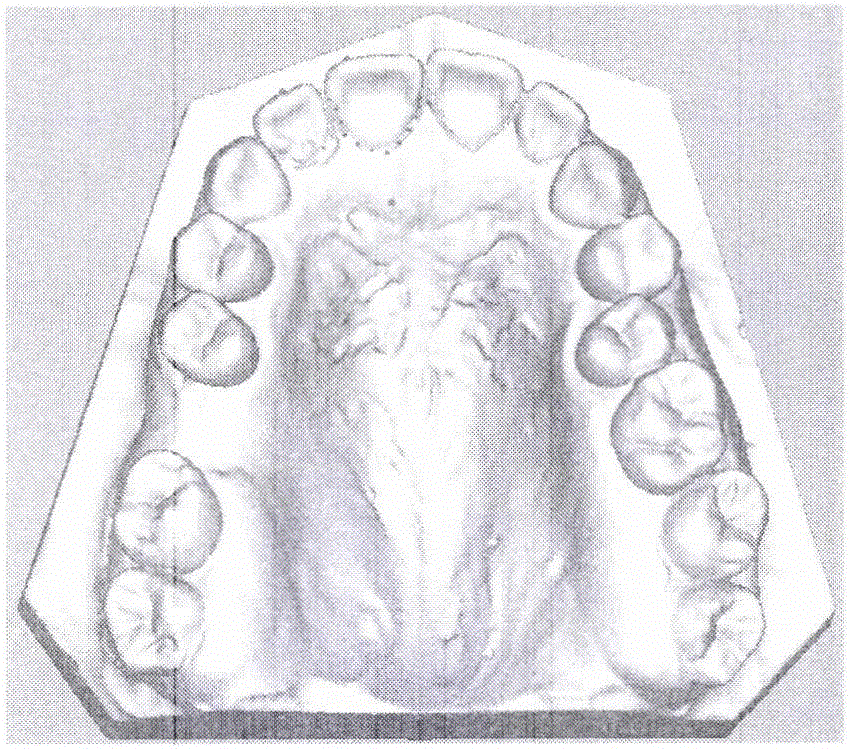 一种基于牙体长轴的质点弹簧模型的牙龈变形仿真方法与流程