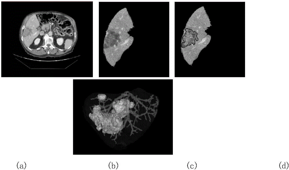 一種三維可視化展示及屬性測量的肝臟功能區(qū)域詮析方法與流程