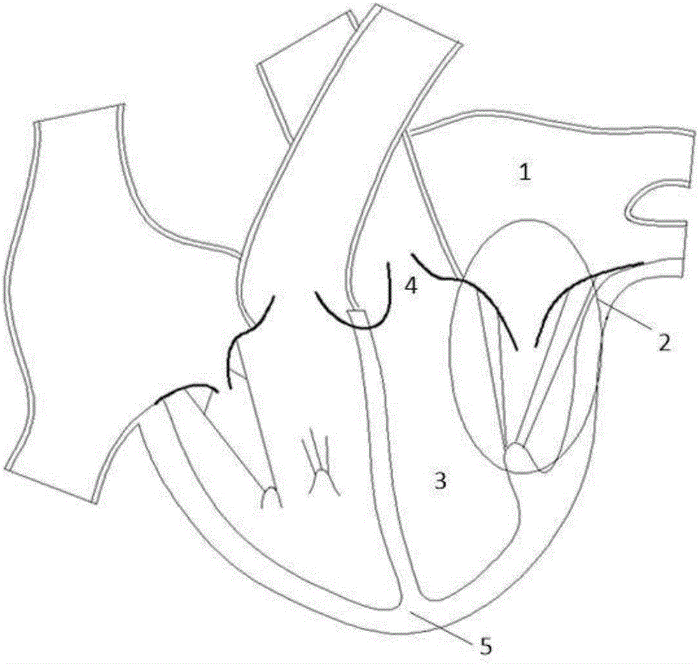 一种经心尖植入的支撑杆式二尖瓣气囊闭合板阻塞体及植入方法与流程