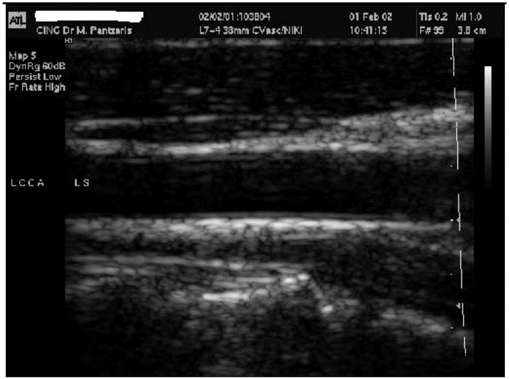 颈动脉超声图像内中膜厚度测量方法及系统与流程