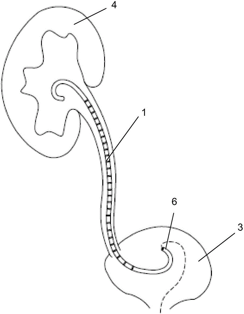 一种具有抗反流功能的输尿管内支架管的制造方法与工艺
