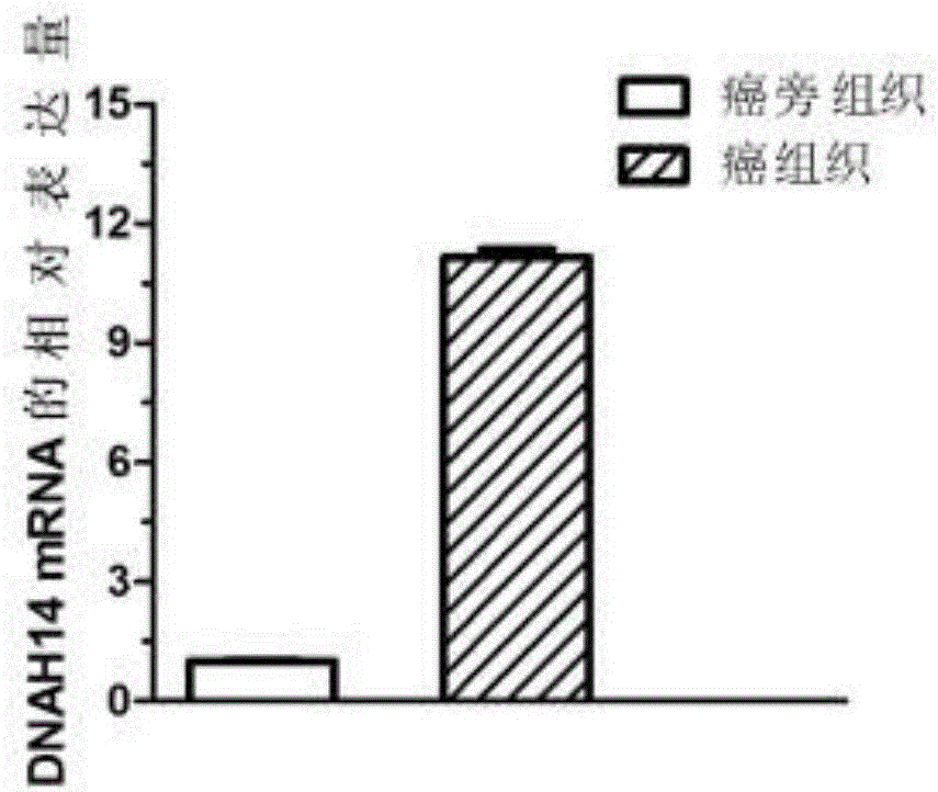 DNAH14基因在腫瘤診治中的應用的制造方法與工藝