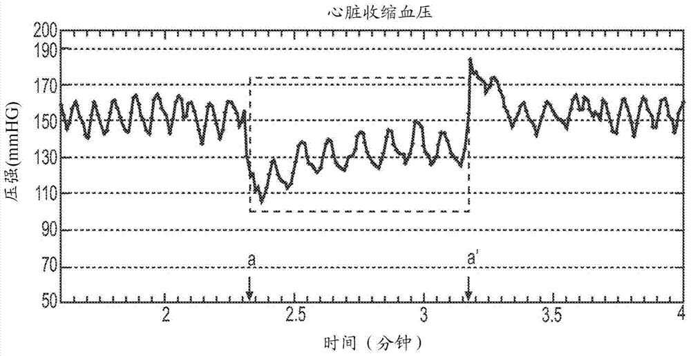 用于通過心室充盈的減少降低血壓的方法和系統(tǒng)與流程