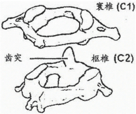 用于寰枢（C1‑2）外侧关节的人工植入物及其使用方法与流程