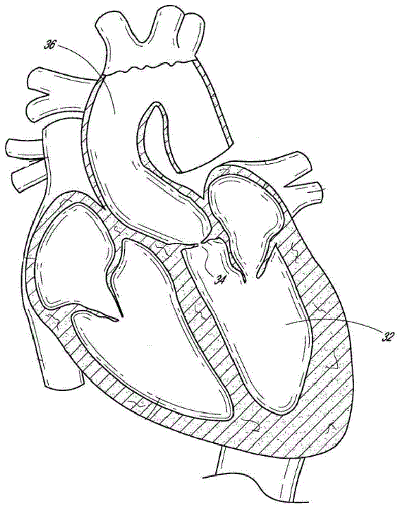 心脏瓣膜假体的制作方法