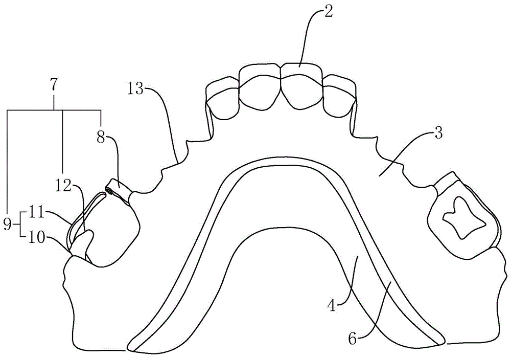 活动义齿支架设计图解图片