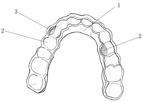 一种牙龈引导成型牙套的制作方法