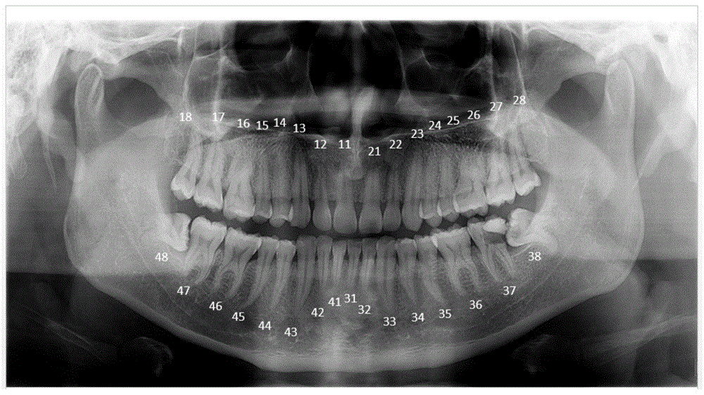 基于深度学习的全景片恒牙识别的方法和装置与流程