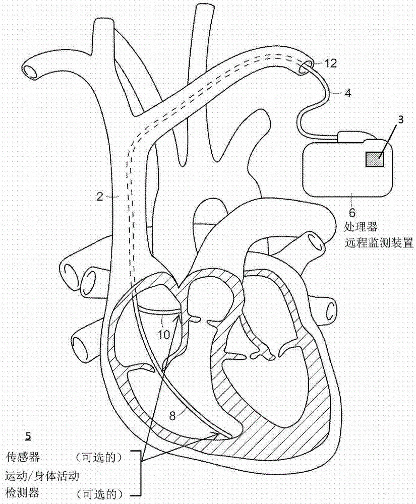 用於使用心臟起搏器進行心肌重塑的技術以及相關係統和方法與流程