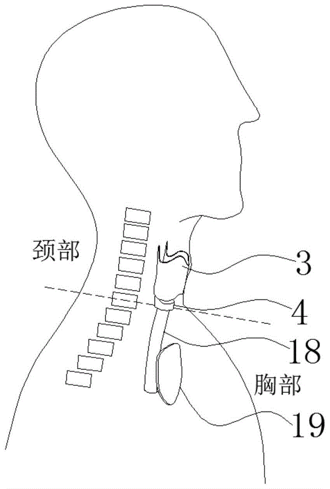 环甲膜位置解剖图图片