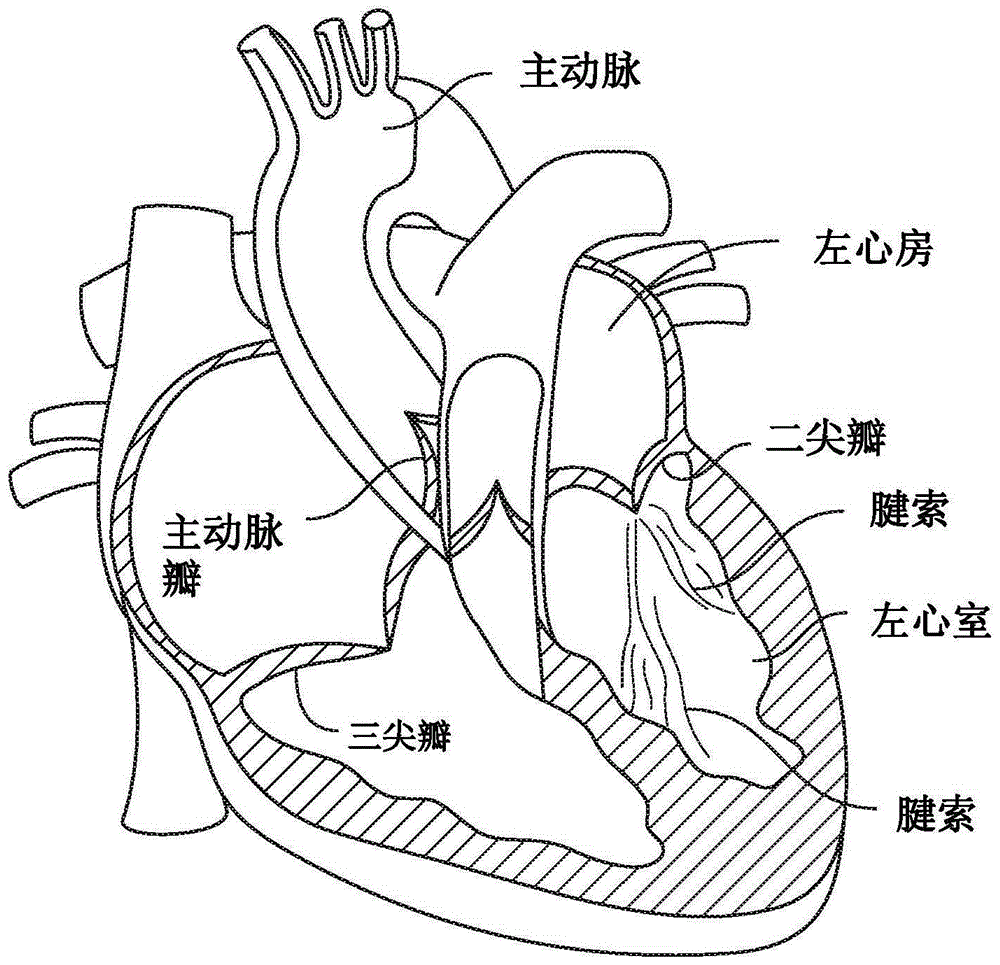被覆盖的假体心脏瓣膜的制作方法