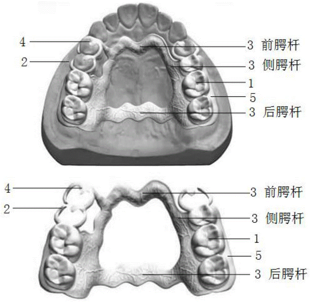 假牙结构图图片