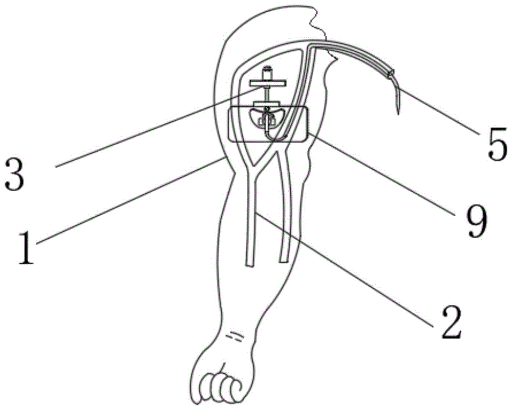 picc管植入解剖图图片