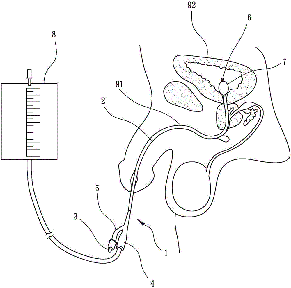 气囊导尿管构造图图片