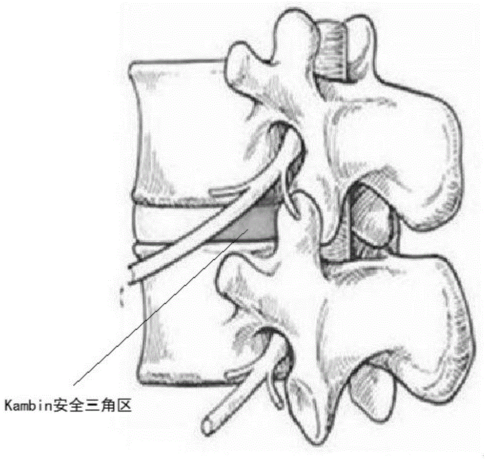 腰骶三角图片图片